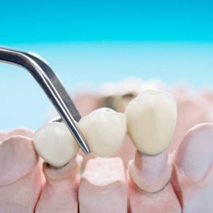 tooth bridge dental care