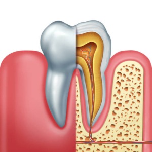 root canal treatment