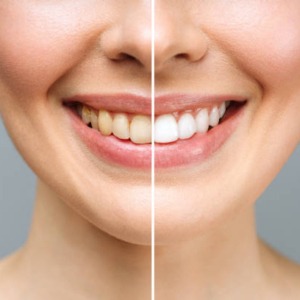 tooth whitening