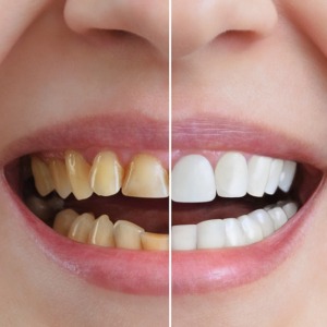 teeth whitening and veneers