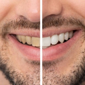 teeth whitening west auckland