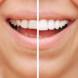 tooth veneers west auckland